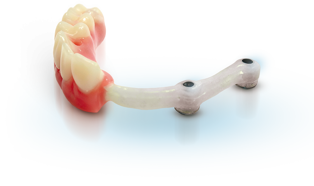 protese fiber pro - Fiber Pro