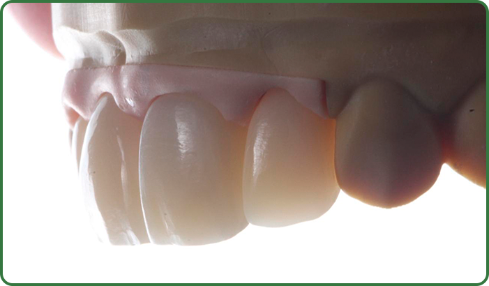 protese foto diego orsine 2 - Voxelprint Temp