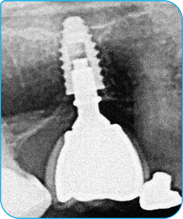 raio x arcsys 1 - Sistema de Implantes Arcsys