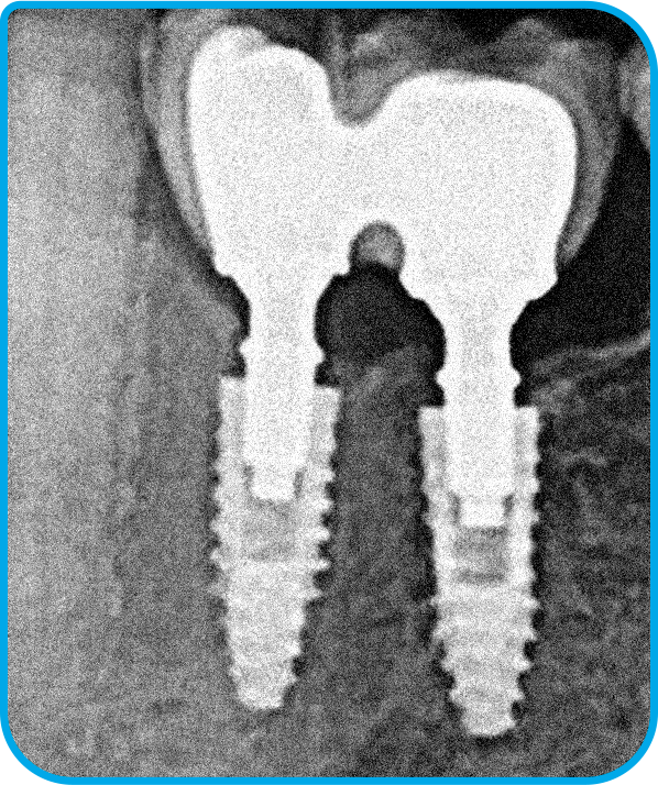 raio x arcsys 3 - Sistema de Implantes Arcsys