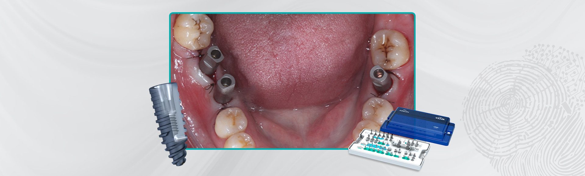 35 Capa Carga imediata com proteses provisorias confeccionadas pelo fluxo digital - Carga imediata com próteses provisórias confeccionadas pelo fluxo digital 35_Capa-Carga-imediata-com-próteses-provisórias-confeccionadas-pelo-fluxo-digital