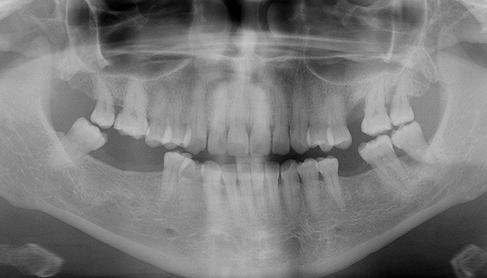 Caso 35 1 - Carga imediata com próteses provisórias confeccionadas pelo fluxo digital 1 | Panorâmica inicial.