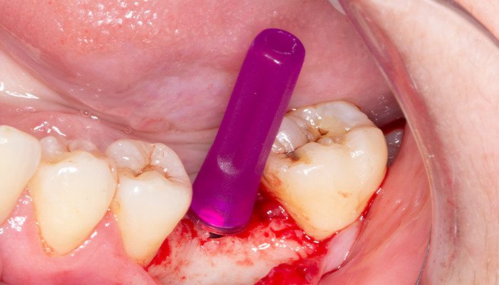 Caso 35 10 - Carga imediata com próteses provisórias confeccionadas pelo fluxo digital 10 | Pilar Aikkon sendo instalado em posição.