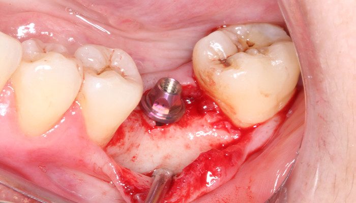 Caso 35 11 - Carga imediata com próteses provisórias confeccionadas pelo fluxo digital 11 | Pilar Aikkon em posição após torque final de 32 N.cm.