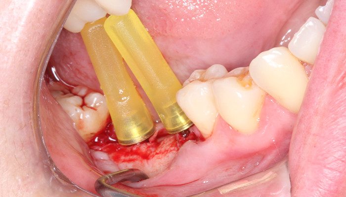 Caso 35 12 - Carga imediata com próteses provisórias confeccionadas pelo fluxo digital 12 | Mini pilares Aikkon sendo instalados.