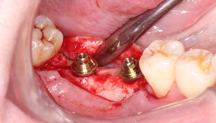 Caso 35 13 - Carga imediata com próteses provisórias confeccionadas pelo fluxo digital 13 | Mini pilares Aikkon instalados após torque final.