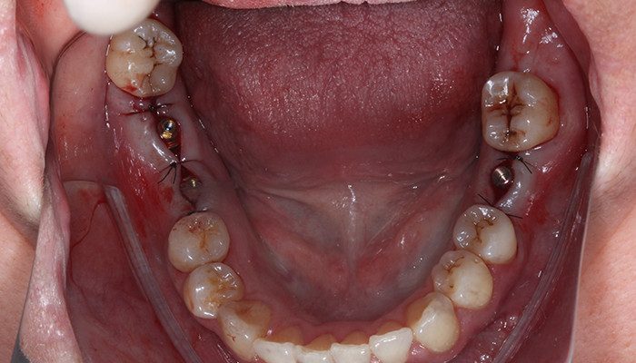 Caso 35 14 - Carga imediata com próteses provisórias confeccionadas pelo fluxo digital 14 | Intermediários Aikkon instalados e sutura realizada.