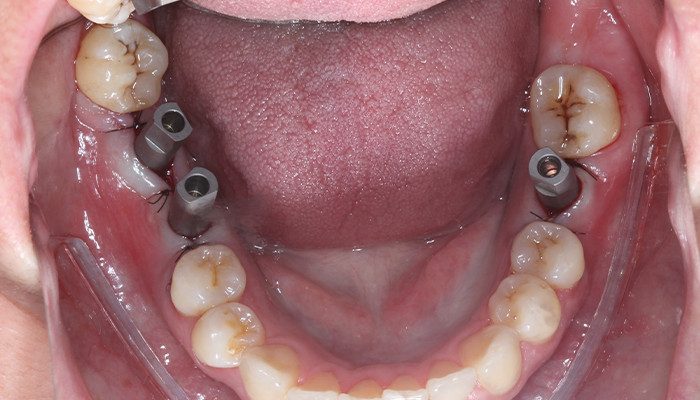 Caso 35 15 - Carga imediata com próteses provisórias confeccionadas pelo fluxo digital 15 | Scan bodies Aikkon instalados.
