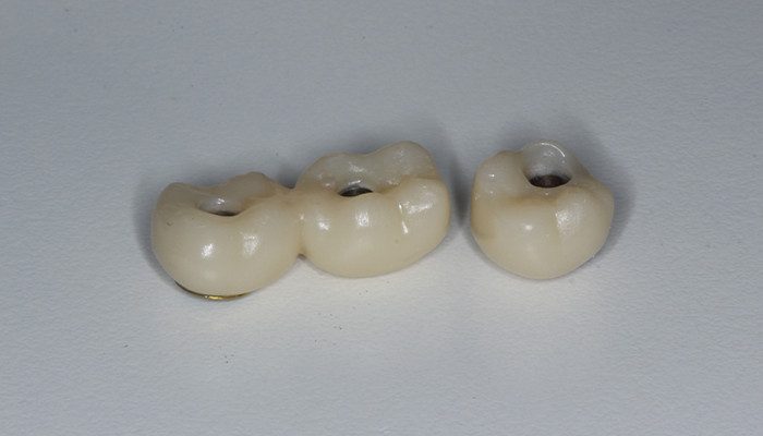 Caso 35 18 - Carga imediata com próteses provisórias confeccionadas pelo fluxo digital 18 e 19 | Coroas provisórias prontas para serem instaladas já com os links metálicos cimentados.