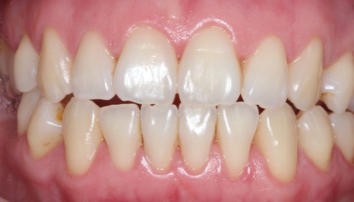 Caso 35 2 - Carga imediata com próteses provisórias confeccionadas pelo fluxo digital 2 e 3 | Aspecto inicial intraoral.