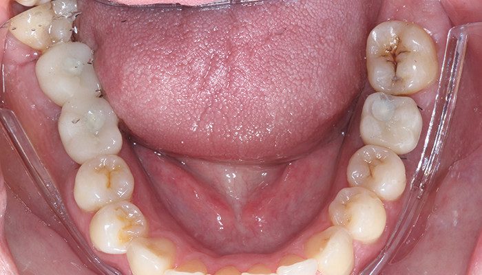 Caso 35 20 - Carga imediata com próteses provisórias confeccionadas pelo fluxo digital 21 | Remoção de sutura e controle 10 dias de pós-operatório – 36 vista vestibular. fluxo digital