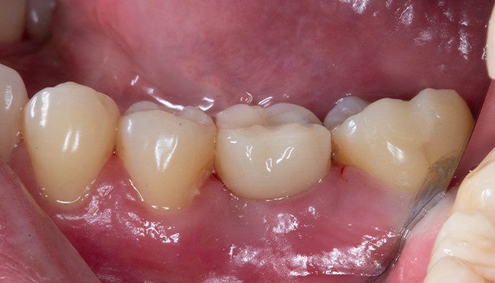Caso 35 21 - Carga imediata com próteses provisórias confeccionadas pelo fluxo digital 22 | Remoção de sutura e controle 10 dias de pós operatório – 46 e 47 vista vestibular.