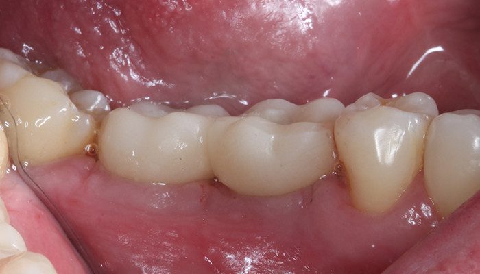 Caso 35 22 - Carga imediata com próteses provisórias confeccionadas pelo fluxo digital 22 | Remoção de sutura e controle 10 dias de pós operatório – 46 e 47 vista vestibular.