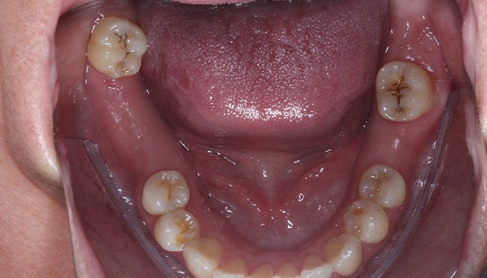 Caso 35 3 - Carga imediata com próteses provisórias confeccionadas pelo fluxo digital 2 e 3 | Aspecto inicial intraoral.