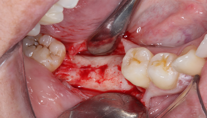 Caso 35 4 - Carga imediata com próteses provisórias confeccionadas pelo fluxo digital 4 | Retalho de espessura total.