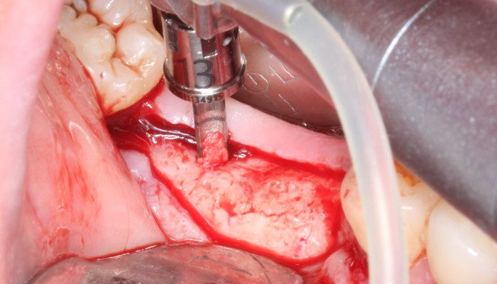 Caso 35 5 - Carga imediata com próteses provisórias confeccionadas pelo fluxo digital 5 | Realização de perfuração única utilizando a broca e o limitador Precision.