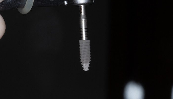 Caso 35 7 - Carga imediata com próteses provisórias confeccionadas pelo fluxo digital 7 | Implante Aikkon 3,8 × 11 mm capturado utilizando a chave instalação monta implante Aikkon.