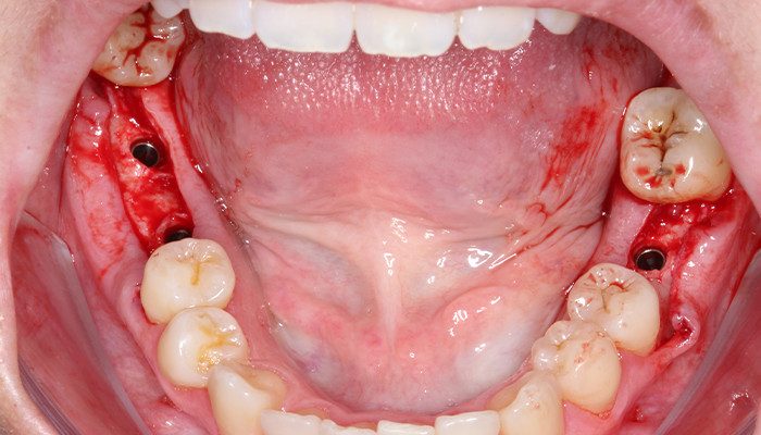 Caso 35 8 - Carga imediata com próteses provisórias confeccionadas pelo fluxo digital 8 | Implantes instalados 2 mm infraósseo.