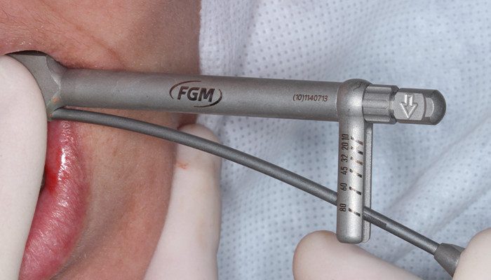 Caso 35 9 - Carga imediata com próteses provisórias confeccionadas pelo fluxo digital 9 | Verificação do torque de instalação do implante 36.