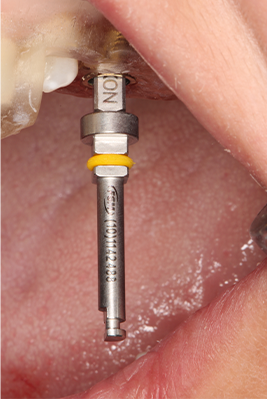 11 | Chave de instalação após desacoplamento do contra-ângulo. 