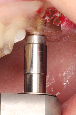 12 | Finalização da instalação com adaptador de catraca CGA. 