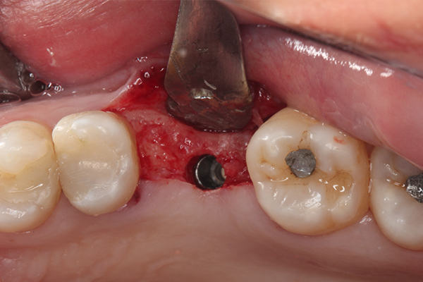 14 | Vista oclusal do implante instalado. 