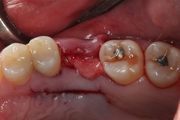 16 | Acomodação do tecido conjuntivo no defeito vestibular do rebordo. 