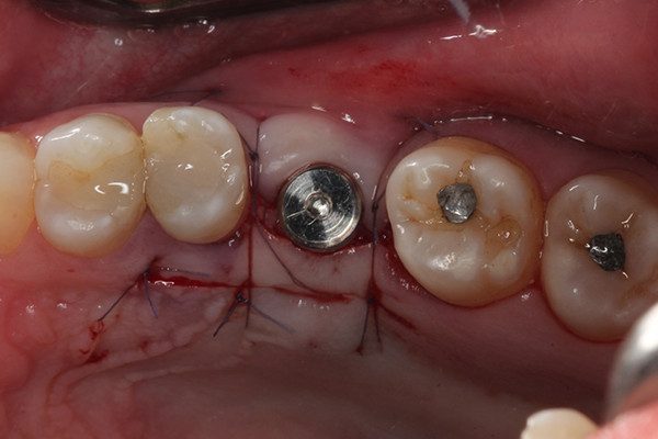 17 | Vista oclusal do cicatrizador e sutura. 