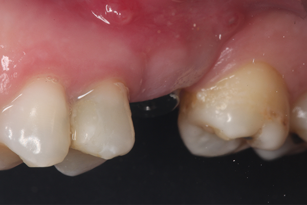 19 | Aspecto tecidual após 21 dias da instalação do cicatrizador. 