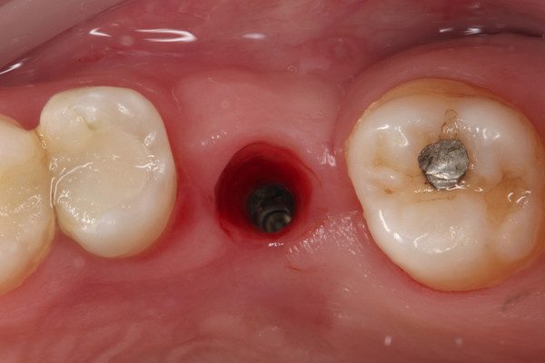 20 | Vista oclusal do tecido periimplantar após 21 dias do procedimento cirúrgico. 
