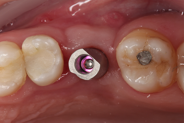 22 | Vista oclusal do scan body instalado sobre o pilar Aikkon.