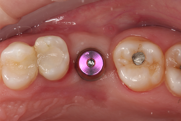 23 | Vista oclusal da coifa de proteção instalada sobre o pilar Aikkon. 24 | Peça modelada em software específico.