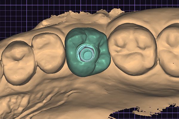 25 | Aspecto oclusal da prótese definitiva após sua instalação clínica. 26 | Vista vestibular da prótese definitiva posicionada sobre o implante Aikkon