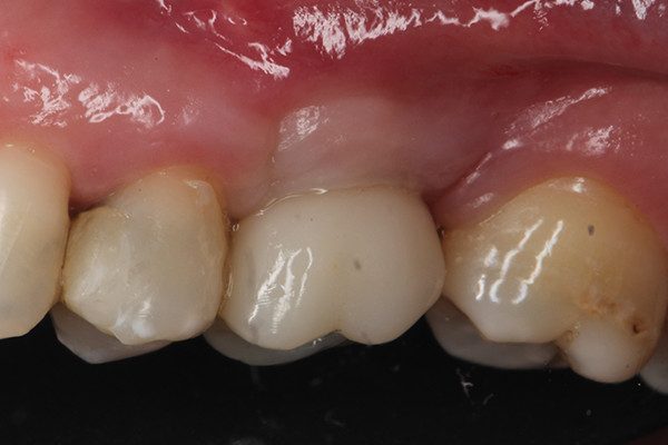 25 | Aspecto oclusal da prótese definitiva após sua instalação clínica.