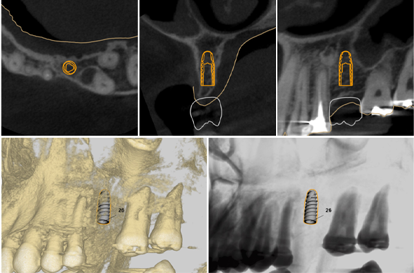 3 | Planejamento cirúrgico virtual.