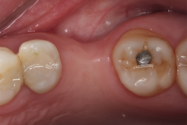 4 | Vista oclusal evidenciando o defeito vestibular do rebordo. 