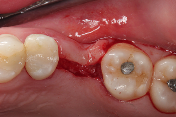 5 | Incisão e descolamento tecidual.