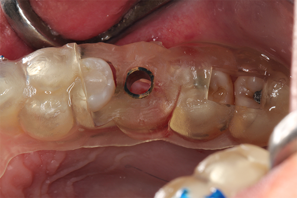 6 | Instalação do guia cirúrgico. 