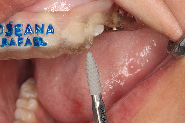 9 | Imagem ilustrativa demonstrando as características macrogeométricas e a microtextura da superfície do implante Aikkon. 