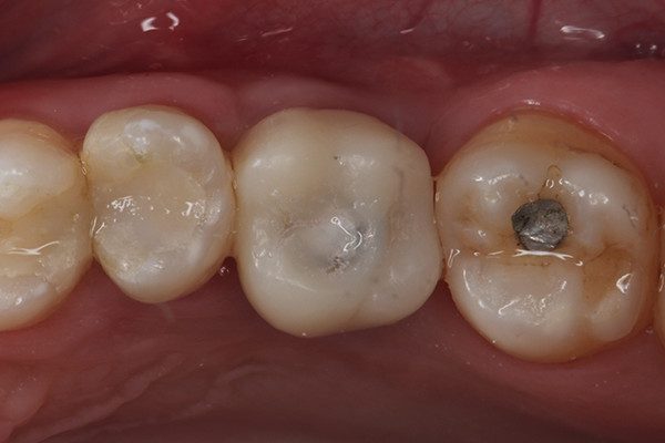 26 | Vista vestibular da prótese definitiva posicionada sobre o implante Aikkon cirurgia guiada