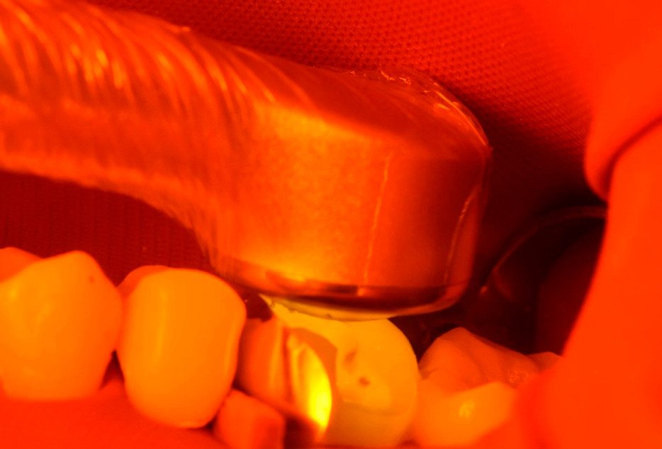 Figura 13: Restauração classe II de resina composta no dente 16. Nota-se a passividade a qual a ponta ativa da fonte de luz QUAZAR atinge a área de tratamento.