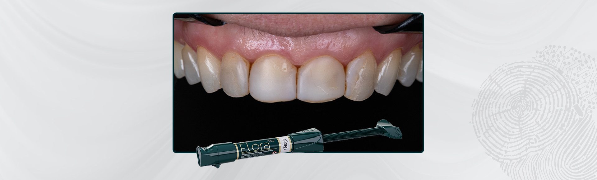 2026-Caso-12_Capa-Facetas-em-resina-composta-com-elóra-aps