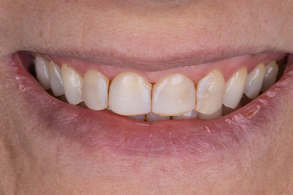 1 e 2 | Aspecto inicial.