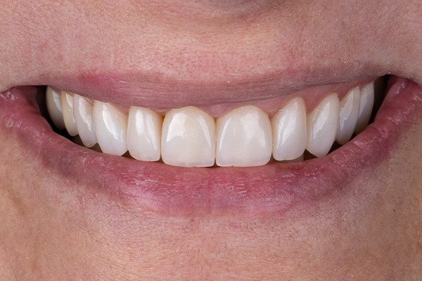 8, 9, 10 e 11 | Resultado após acabamento e polimento.