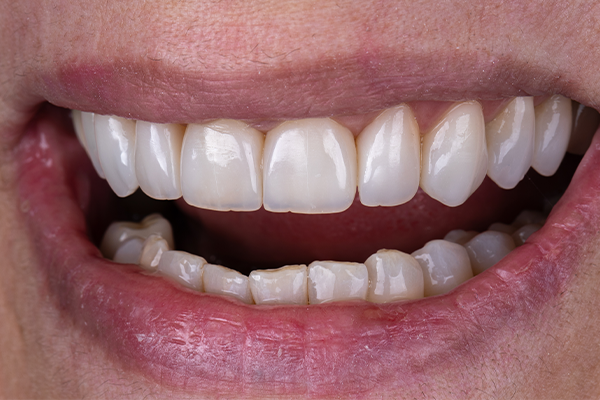 8, 9, 10 e 11 | Resultado após acabamento e polimento.