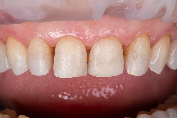 3 | Aspecto após a remoção das resinas insatisfatórias.