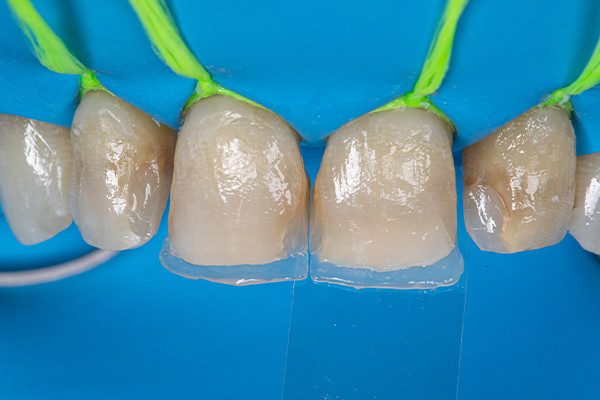 4 | Conchas palatinas feitas com matriz de poliéster e resina Elóra APS, na cor Trans.