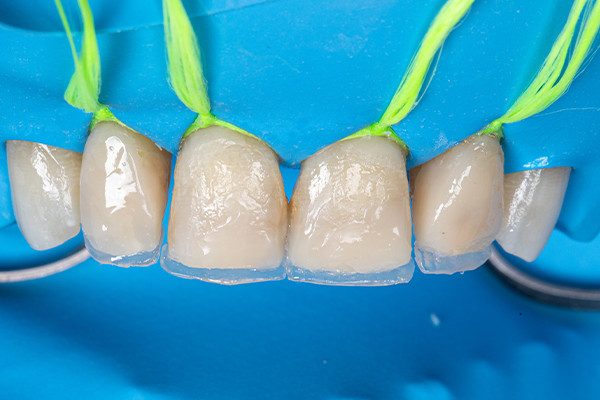 26 Caso 12 5 - Facetas em resina composta com Elóra APS