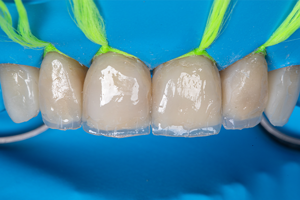 6 | Áreas proximais com Elóra APS, na cor A1, camada de dentina com Elóra APS, na cor BL, efeitos incisais com Assist APS Opaquer, na cor OW e Vittra APS Flow, na cor Trans.