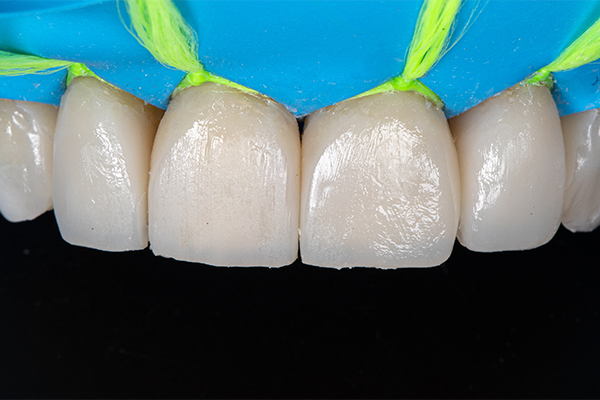 7 | Camada de esmalte final com resina composta Elóra APS, na cor WE.